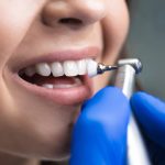Dentálna hygiena: Aké prináša výhody?